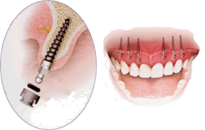 Mini-Implantes-1